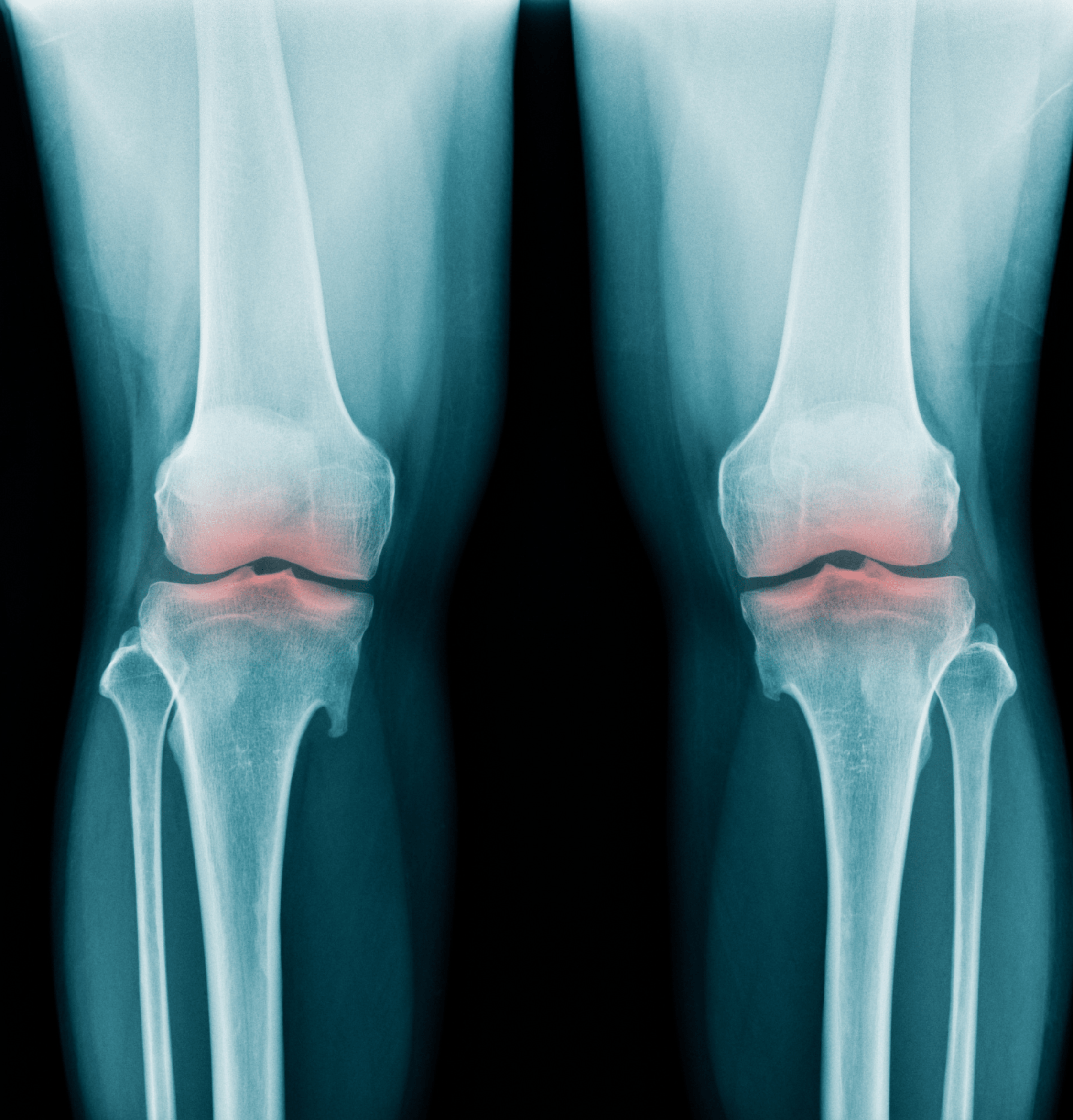 Radiografia Ginocchio