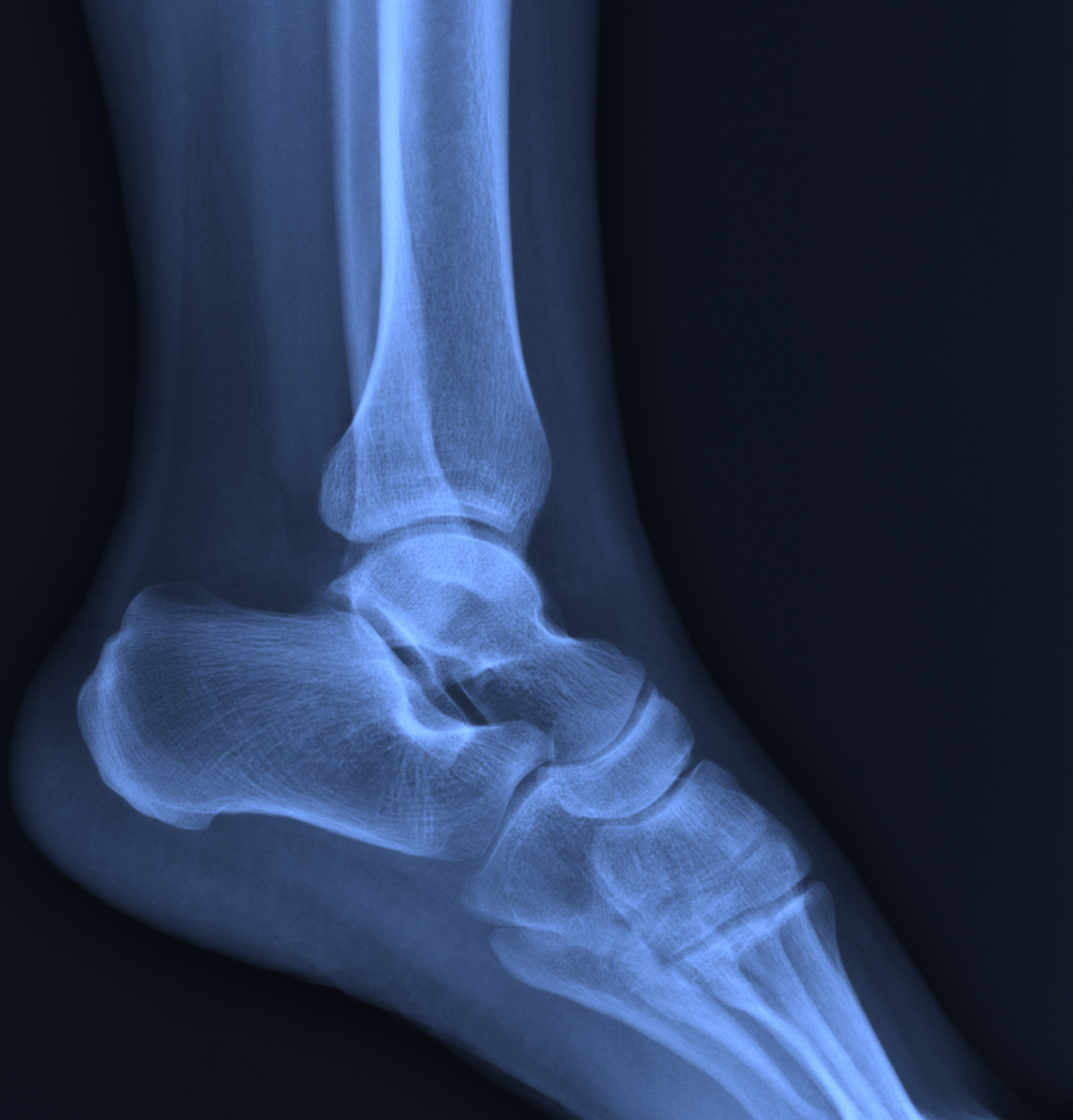 Radiografia caviglia