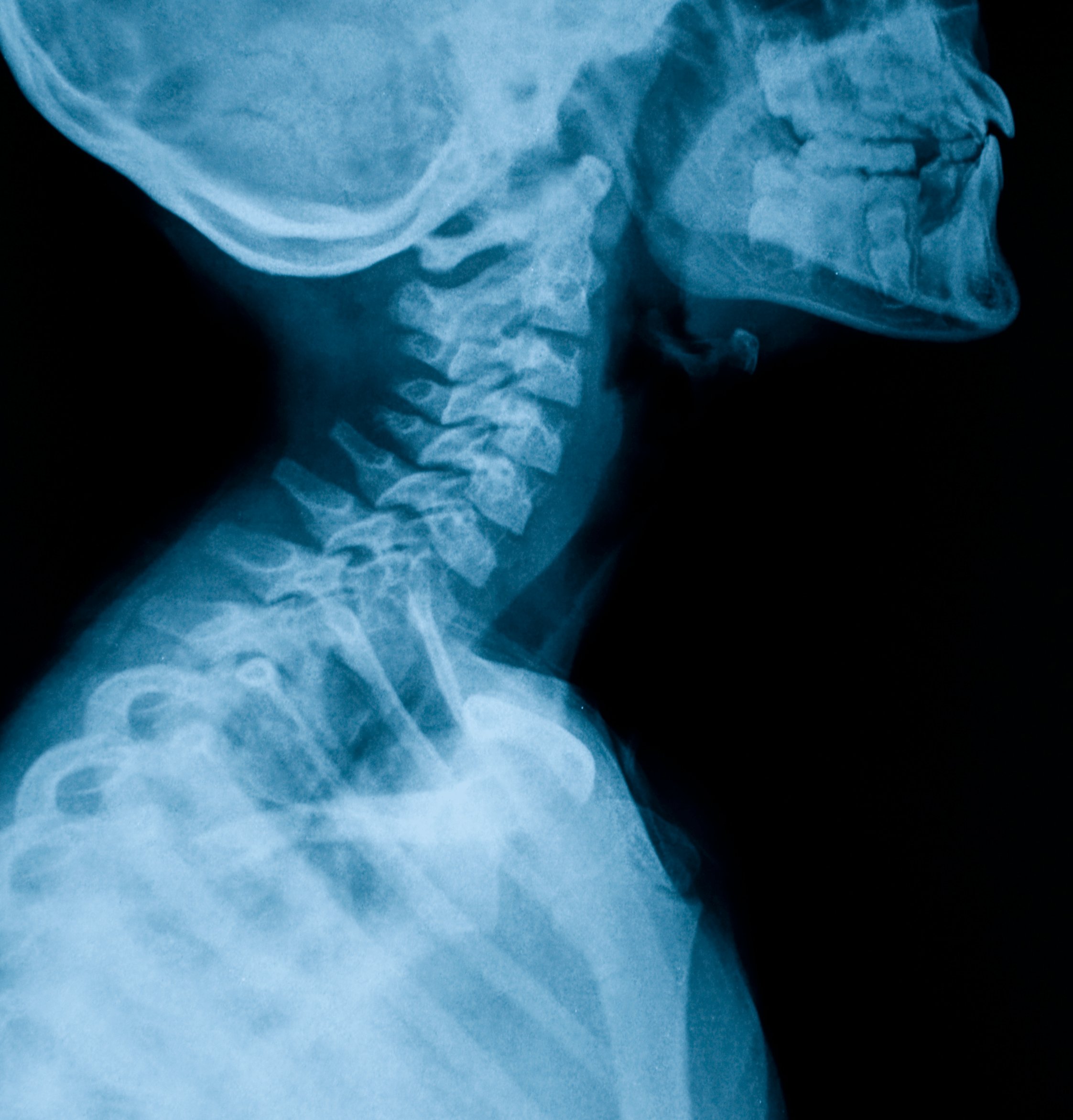 Radiografia cervicale